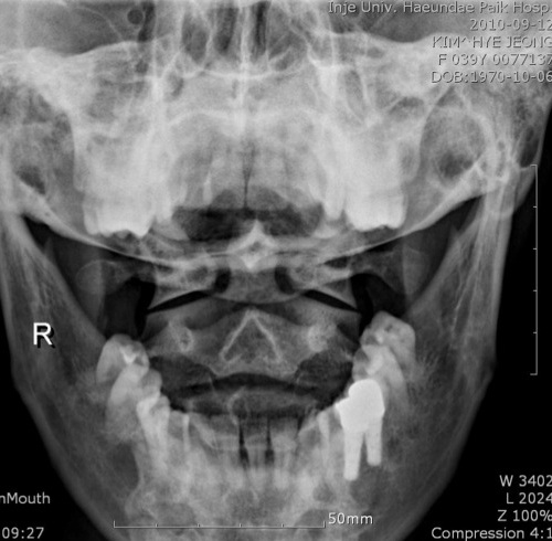 Figure 2 for case fibrous dysplasia ( RID3738 )